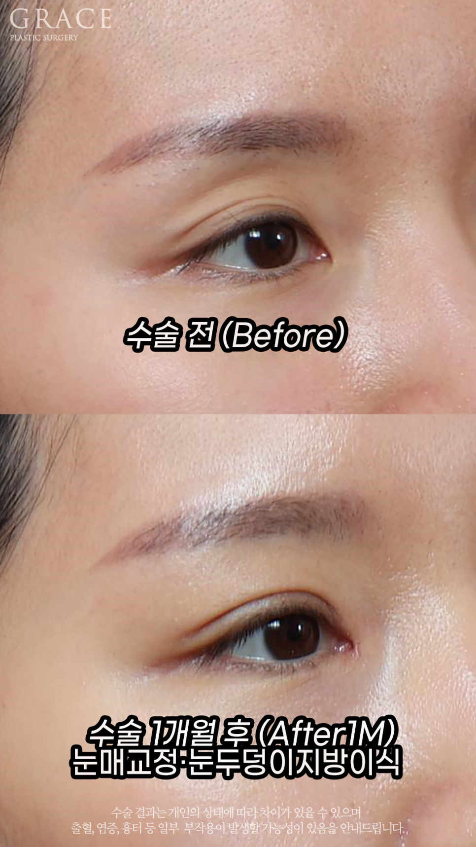 Before and After Upper Eyelid Fat Grafting for Women in Their Early 30s image 3