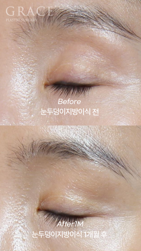눈 위 지방이식 감으면 울퉁불퉁? 왜? 관련 이미지 6