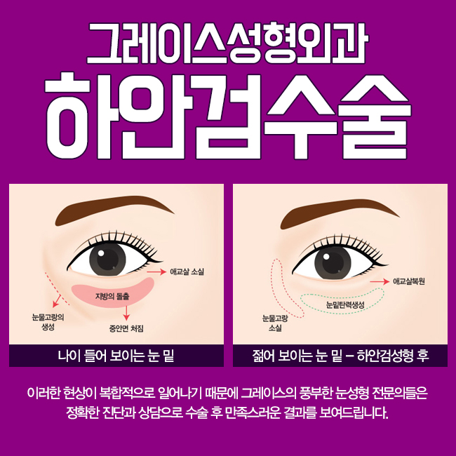 밝아지는 인상 하안검수술후기가 궁금하다면 관련 이미지 2
