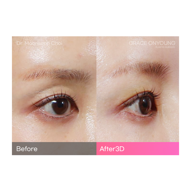 Are You Considering Fat Grafting for Hollow Upper Eyelids? image 3