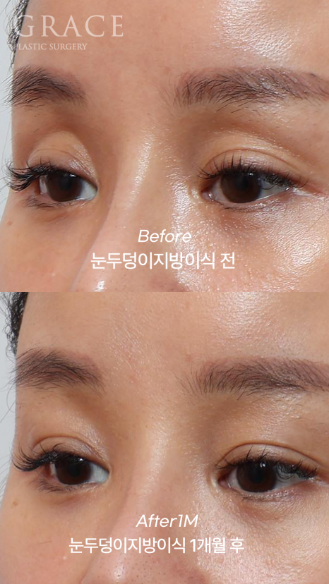Why Injecting Fat Into the “Orbital Fat” Is Important in Sunken Eye Fat Grafting (dr.essay) image 4