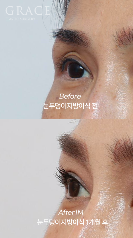 Uneven When You Close Your Eyes? Before-and-After of Eyelid Fat Grafting That Took Well Without Swelling (Compared with Filler) image 7
