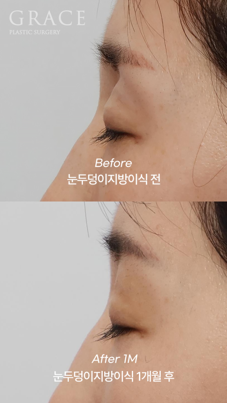 Eyelid Fat Grafting Side Effects? How to Settle In Beautifully Without Lumps image 11