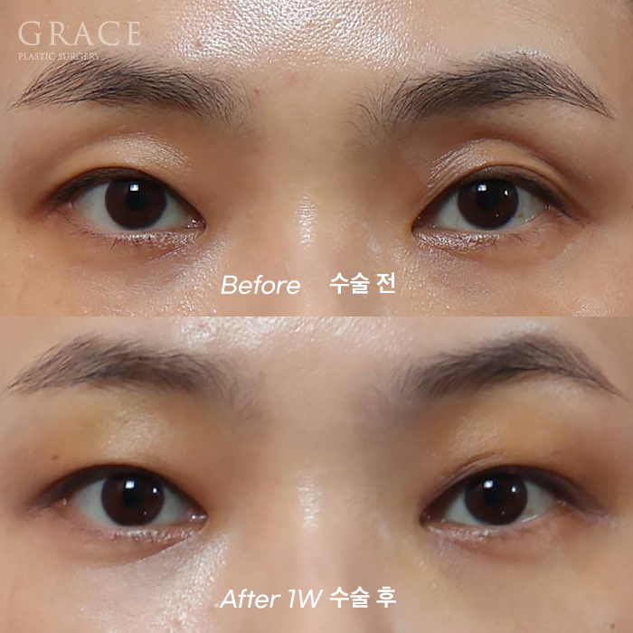 1 Week After Forehead Fat Grafting for Sunken Eyes: Honest Swelling Update image 1
