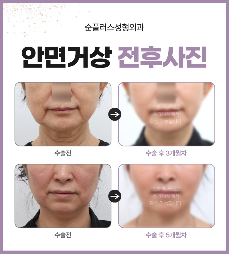 Will the Effects of a Facelift Last a Long Time? image 5