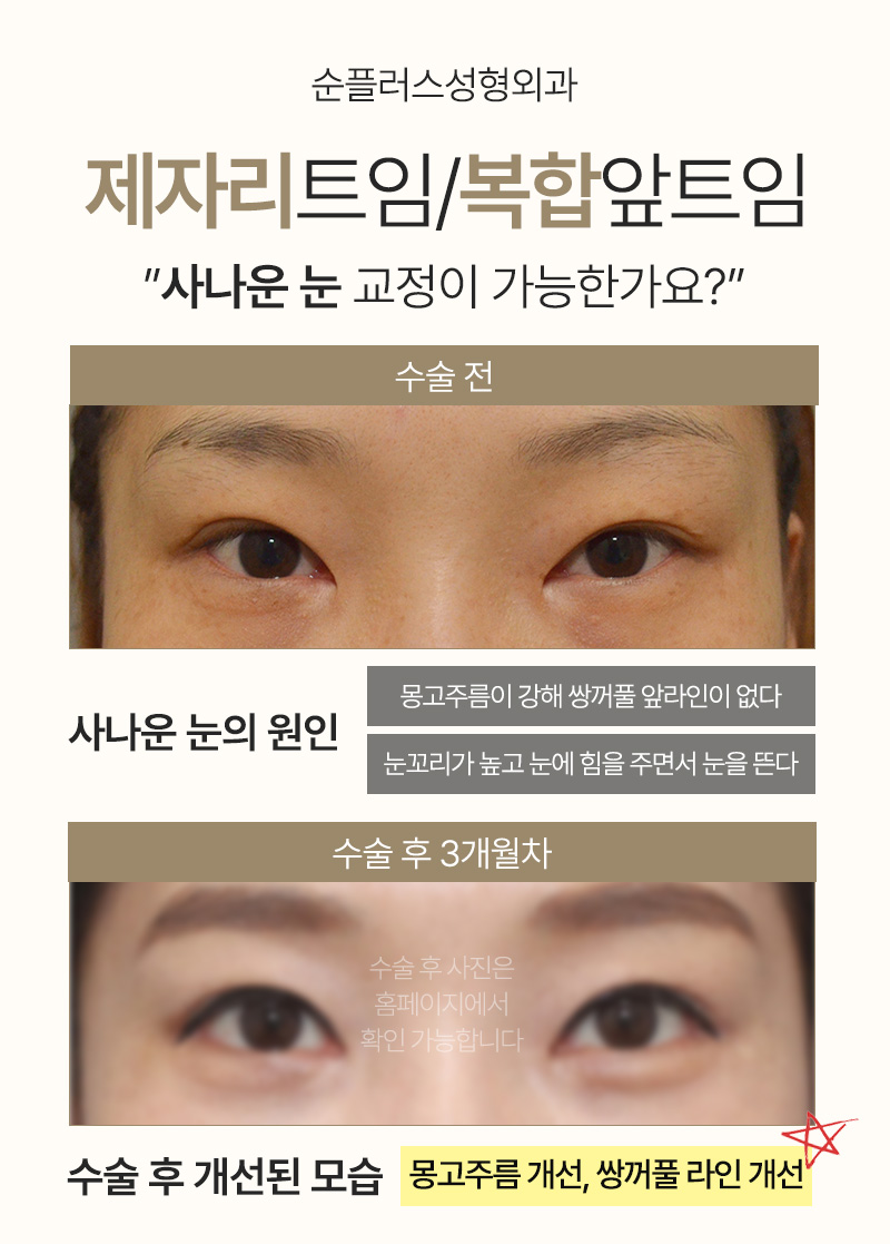 트임 부작용 개선과 몽고주름 제거로 눈매를 부드럽게 [앞트임-제자리트임] 관련 이미지 4