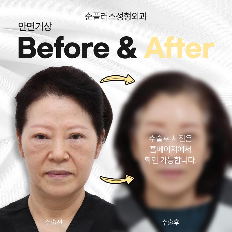 안면거상 근막층까지 당겨주는 스마스리프팅 통해 관련 이미지 5