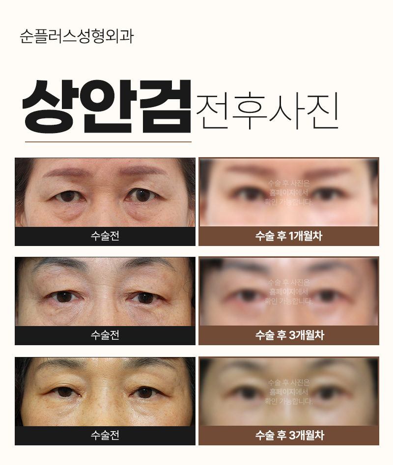 노화로 처진눈꺼풀 자연스러운 쌍꺼풀라인 위해 관련 이미지 4