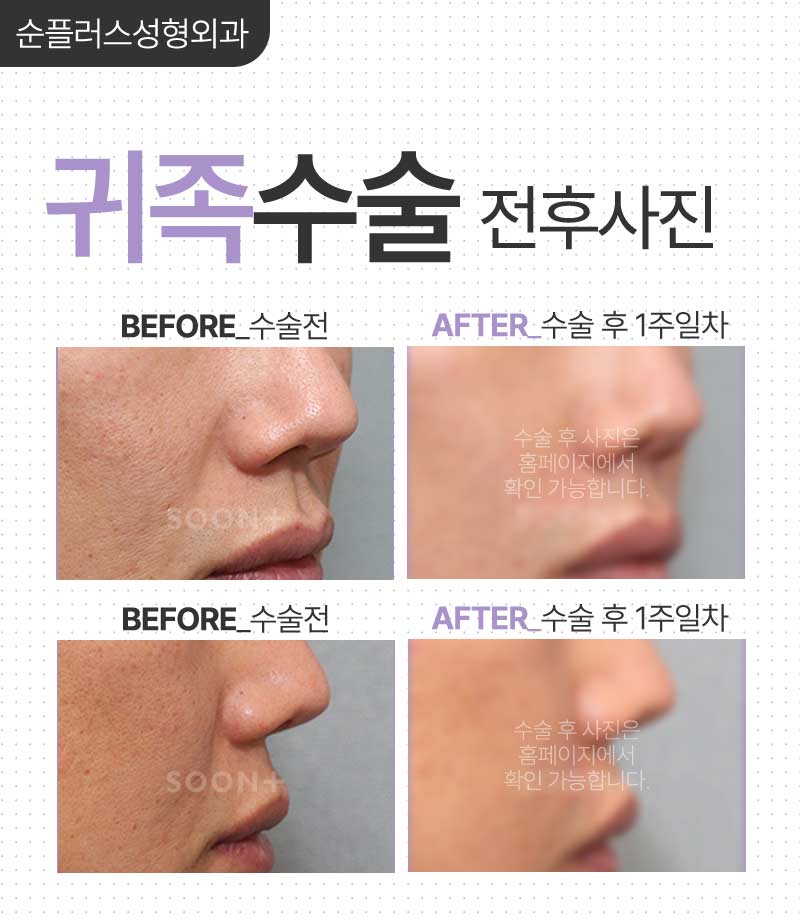 팔자주름 돌출입 개선에 보형물 넣는 귀족수술로 효과본다면? 관련 이미지 7