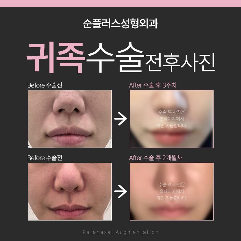 If You Want Natural Improvement of Nasolabial Folds and a Short Recovery Period, Consider Noble Surgery Using an Implant image 4