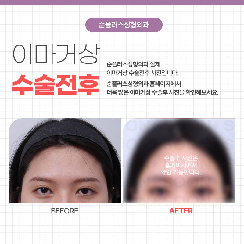 내시경이마거상 추천케이스가 따로 있나요 관련 이미지 5