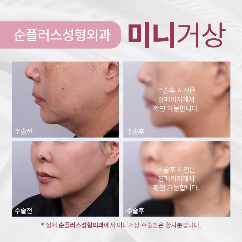 미니거상 수술 빠른 회복은 덤 관련 이미지 6