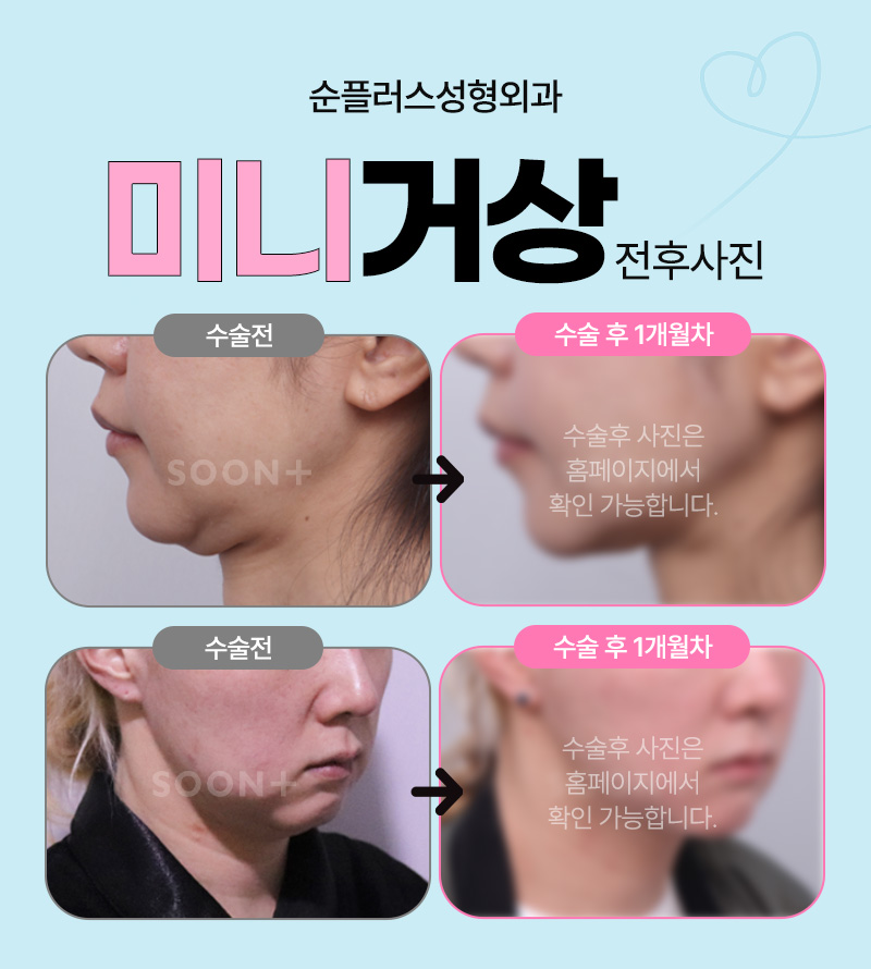 Mini Facelift to Improve Loose Skin Elasticity image 5