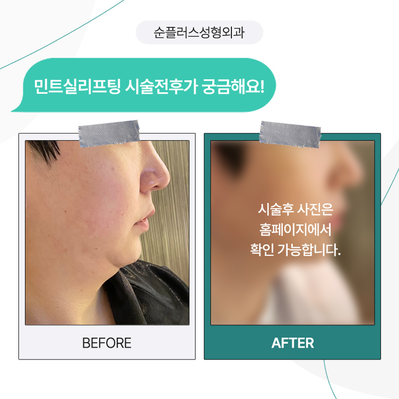 늘어진 턱라인 정리를 위한 민트리프팅 [실리프팅] 관련 이미지 6
