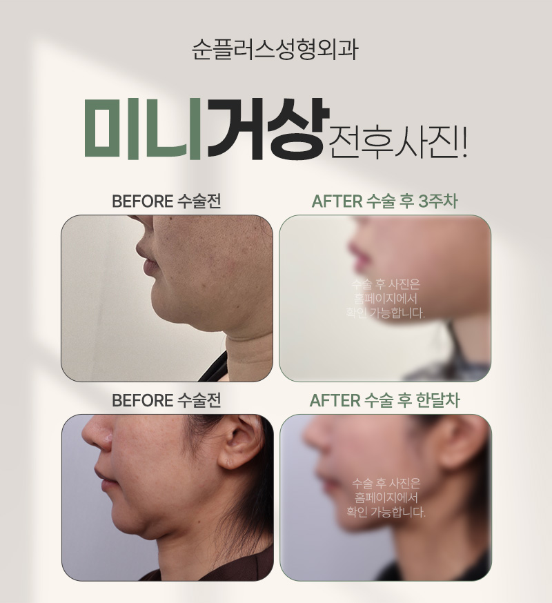 미니안면거상술 부작용 줄이고 효과 유지기간 만족하려면 관련 이미지 4