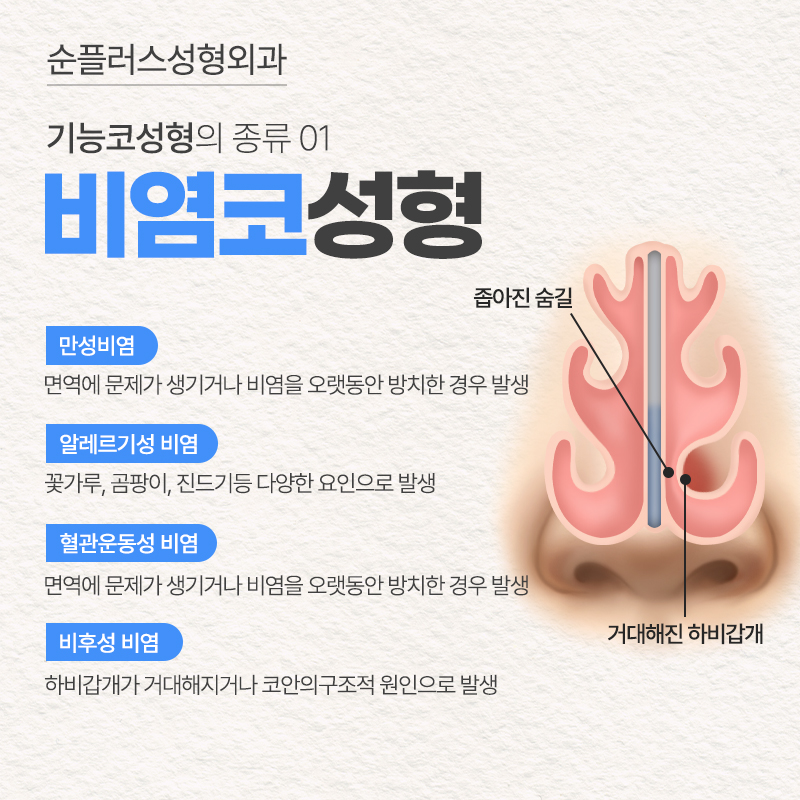 기능코수술 미용적 개선과 비염 비중격만곡증 개선으로 편안한 숨길 관련 이미지 3