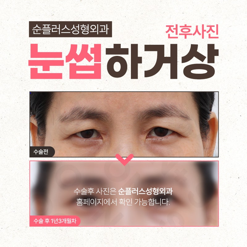 처지는 눈꺼풀 중년눈수술 눈썹하거상 관련 이미지 6