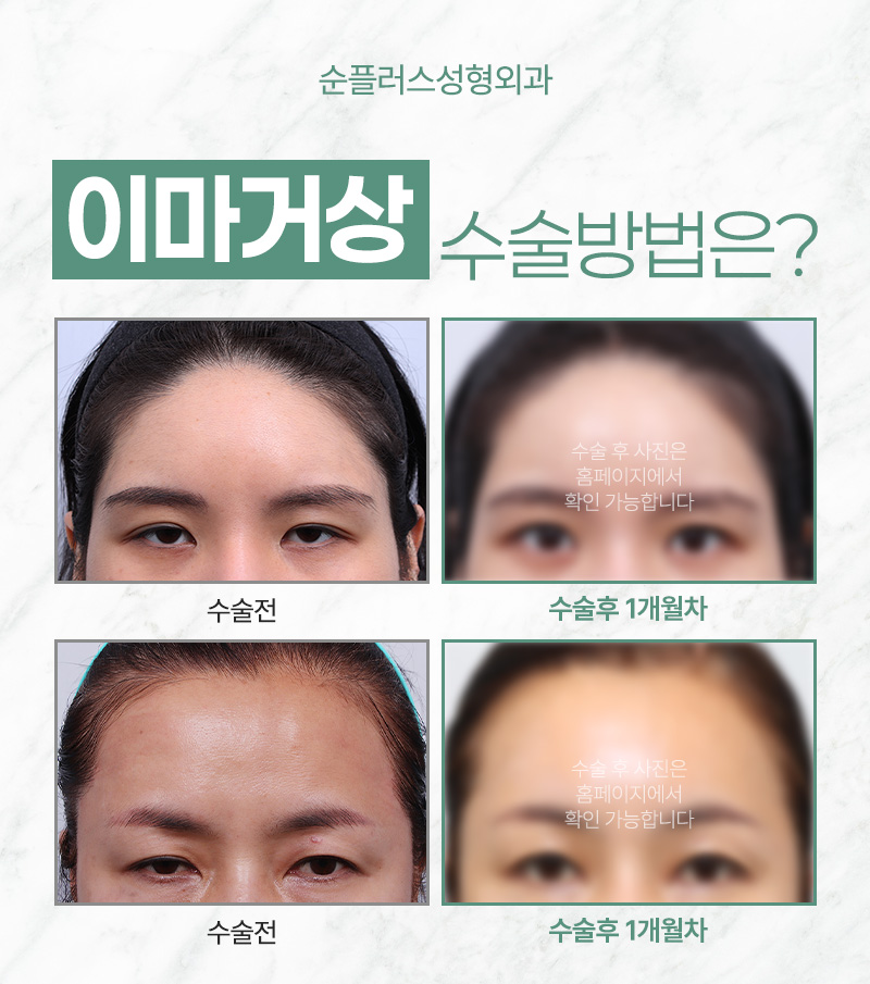 Learn About the Effects and Price of Endoscopic Forehead Lift Surgery. image 6