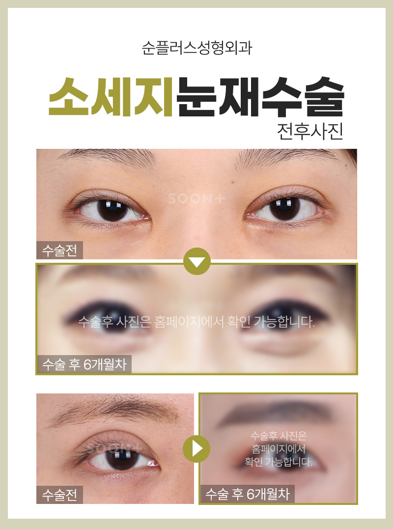 소세지눈재수술 원인 파악하고 그에맞는 플랜으로 관련 이미지 5