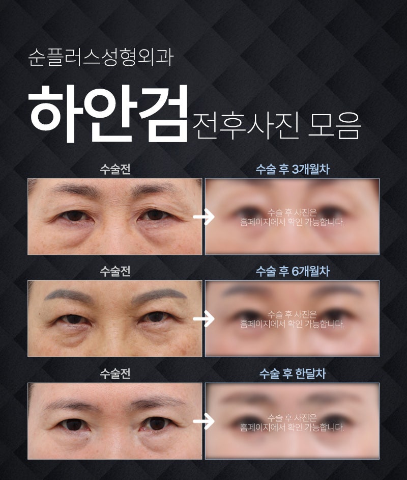 Under-Eye Fat Surgery: What to Do When Fat Builds Up with Aging and Under-Eye Sagging Appears image 3
