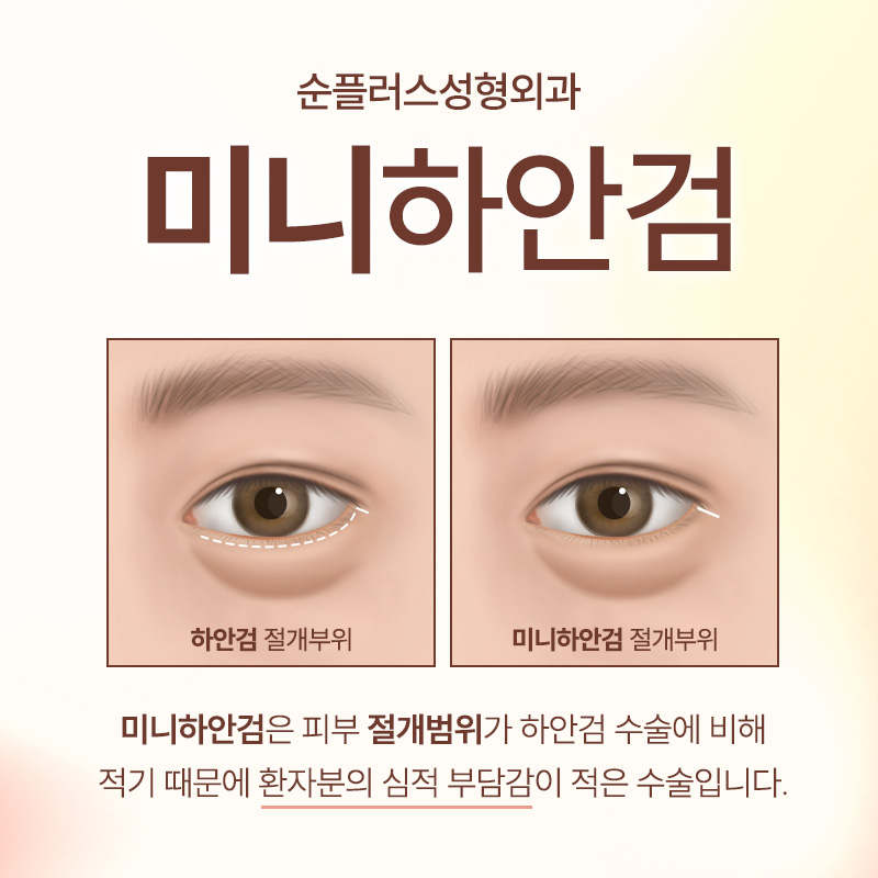 Mini Lower Blepharoplasty Depending on the Degree of Under-Eye Sagging image 5