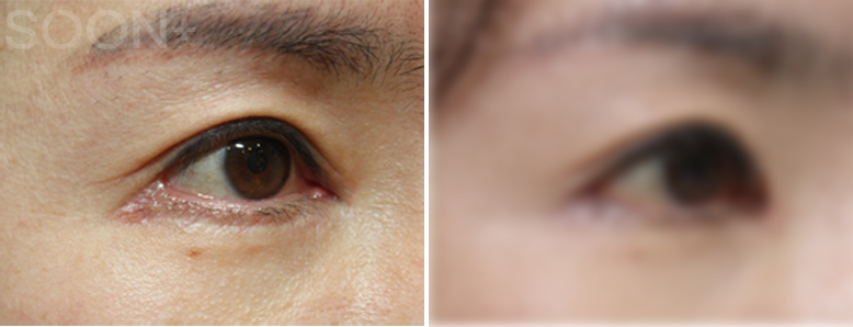 The approach to revision outer corner surgery varies depending on the cause image 9
