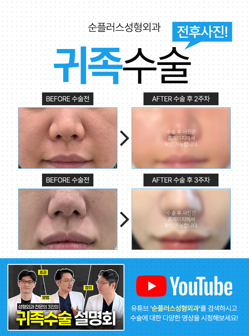 중안면 꺼짐&팔자주름 고민, 귀족수술로 해결하는 방법 관련 이미지 5