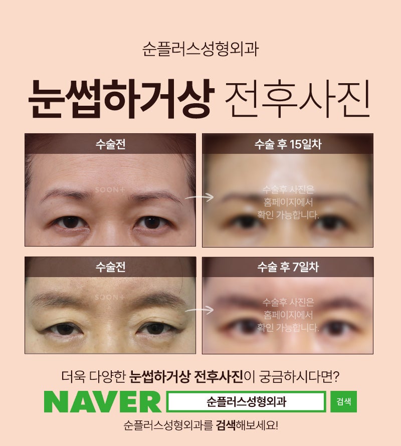 Eyebrow Lift Surgery Chosen by Celebrities for a Natural Youthful Effect image 6