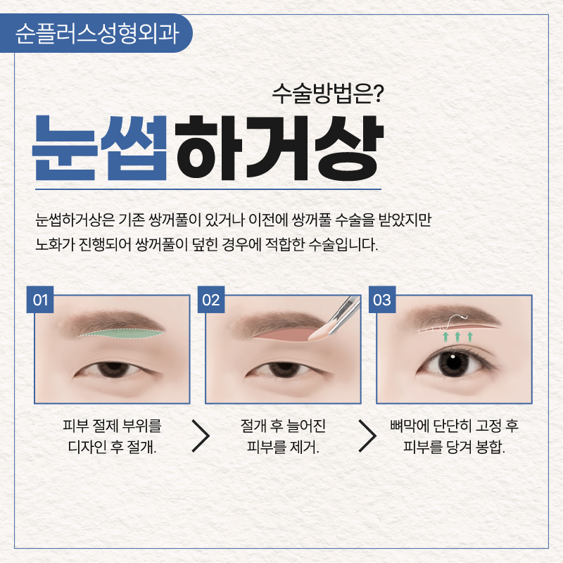 눈과 눈썹사이가 멀고 눈매가 답답해 보인다면 눈썹하거상술로 개선의 기대를 관련 이미지 4