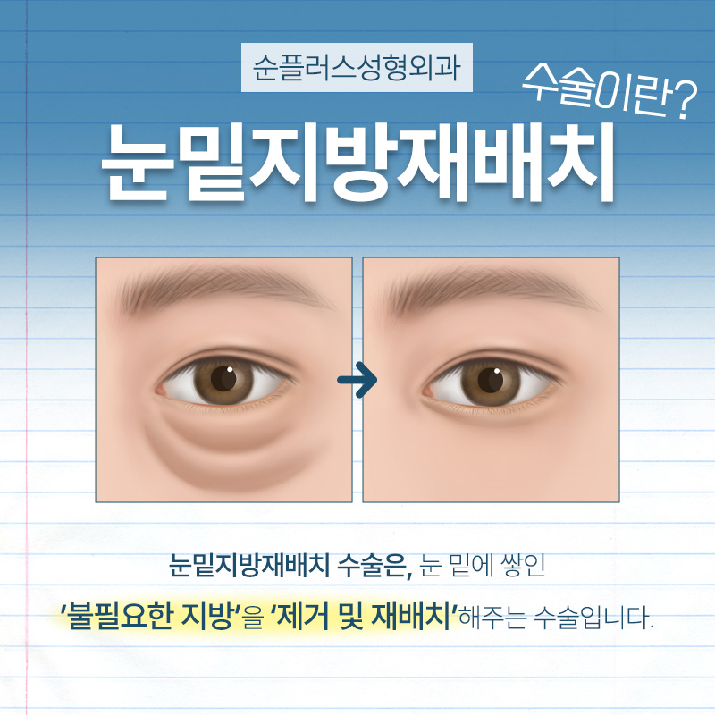 눈밑지방재배치잘하는병원 추후 재발예방하고 관련 이미지 3