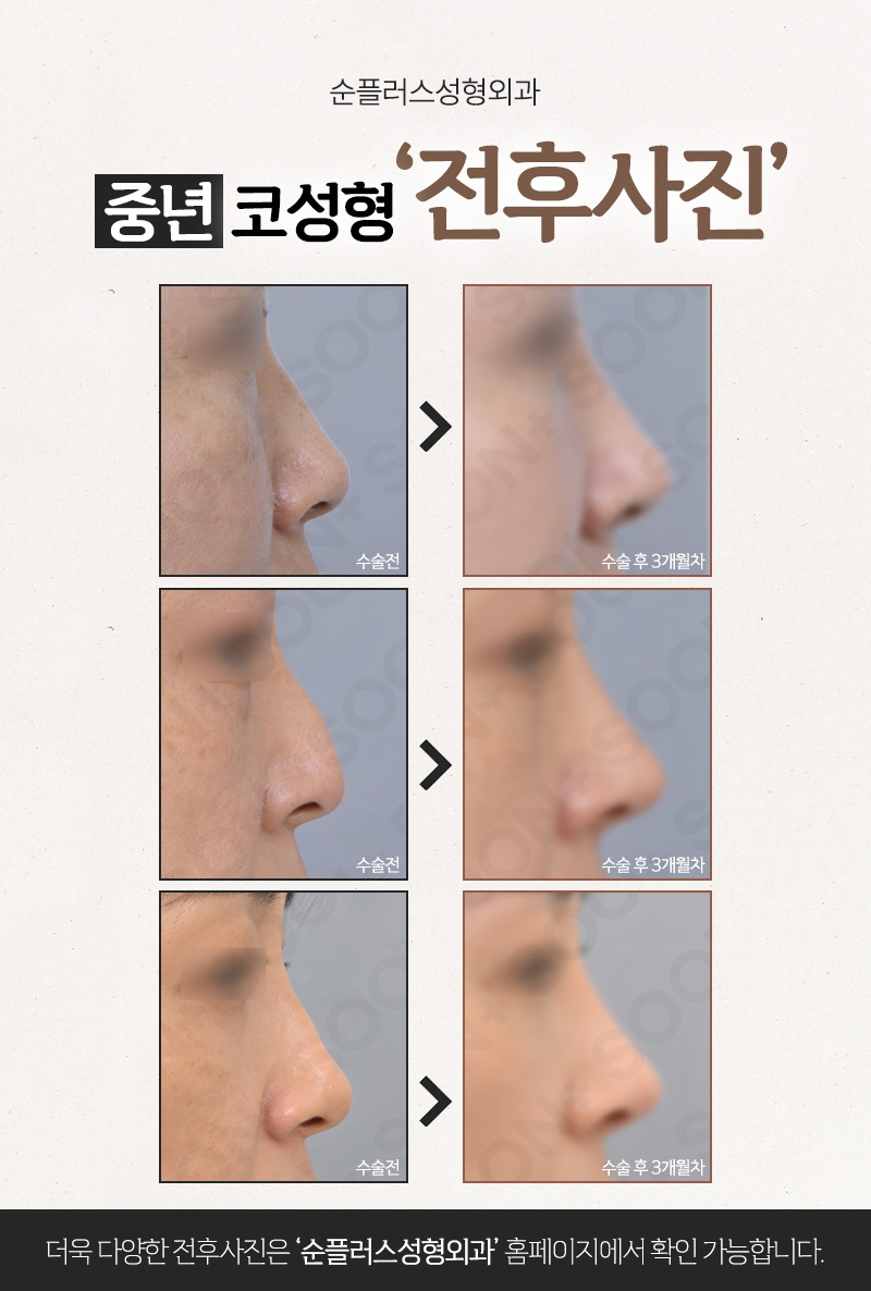 Midlife Rhinoplasty for People in Their 40s, 50s, and Older: Why Naturalness Matters image 3