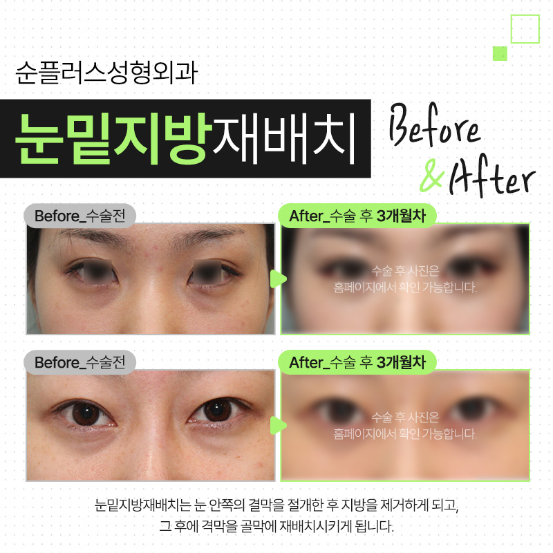 Hospital Recommendation for Under-Eye Fat Repositioning: If the Under-Eye Area Looks Uneven image 5