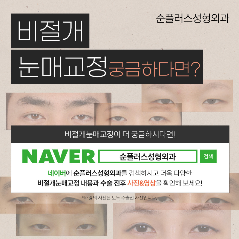 비절개눈매교정 전후 후기 다양한 케이스 확인하며 관련 이미지 6