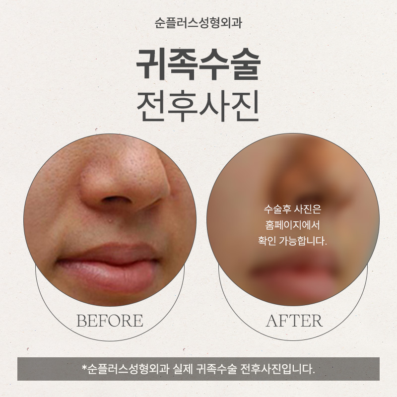 팔자주름보형물 개인별 맞춤 제작이 된다고? 관련 이미지 5