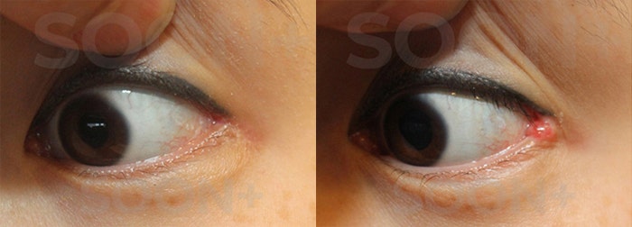 The approach to revision outer corner surgery varies depending on the cause image 5
