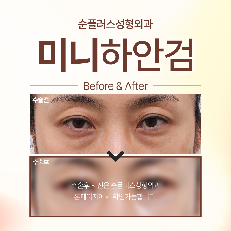 Mini Lower Blepharoplasty Depending on the Degree of Under-Eye Sagging image 3