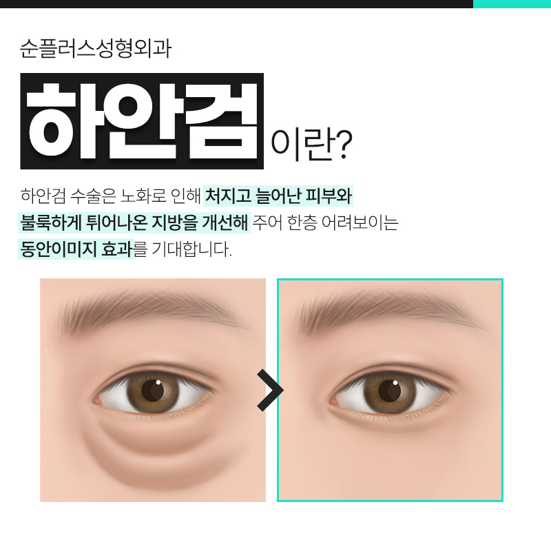 Best Place for Lower Blepharoplasty: More Than Just Fat Removal, Including Sagging Skin image 2