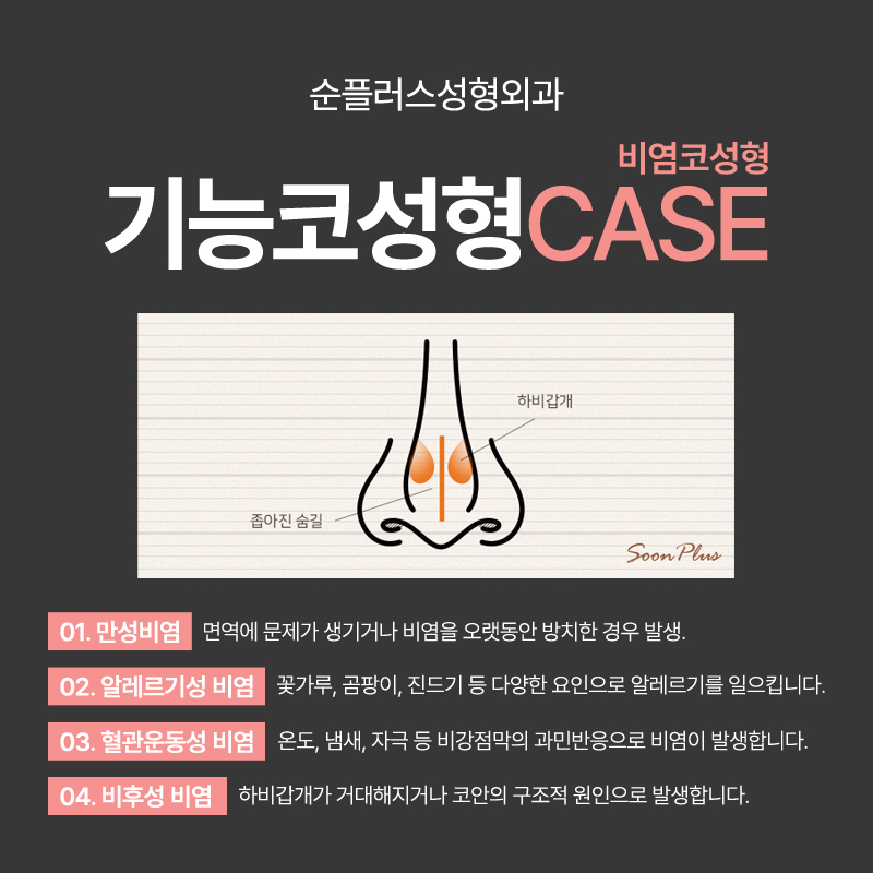 기능코수술 비염 등의 기능적 개선에 콧대 라인까지 관련 이미지 5