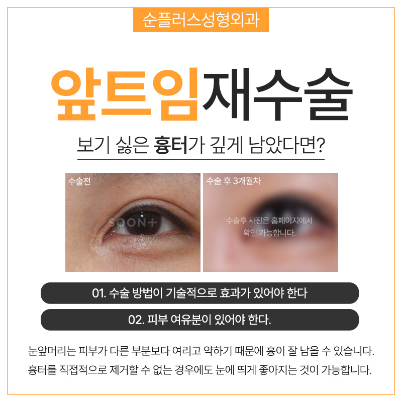 앞트임재수술 복원으로 눈앞머리 자연스럽게 관련 이미지 6