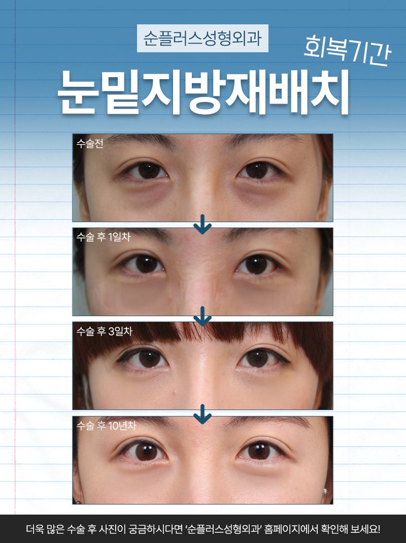 눈밑지방재배치잘하는병원 추후 재발예방하고 관련 이미지 6