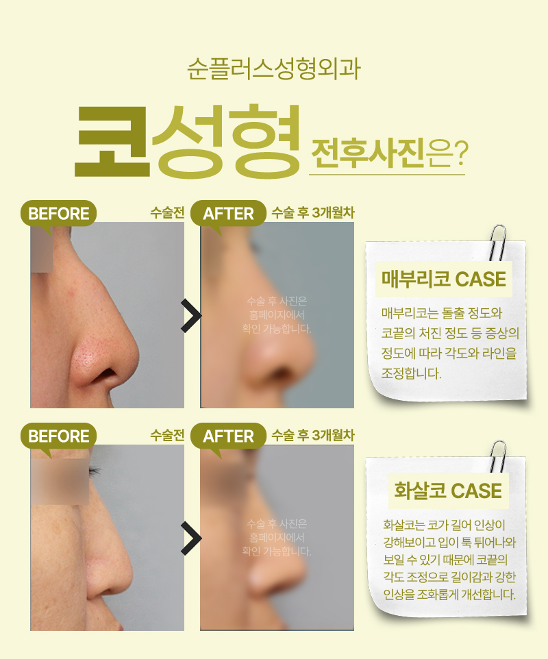 첫코성형 비율과 균형을 맞춰 입체감을 극대화 관련 이미지 5