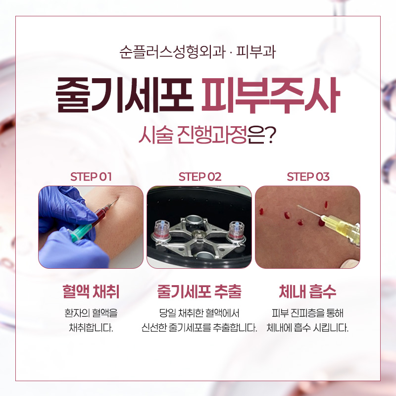 Stem Cell Skin Injection: An Effect That Improves the Skin Environment Itself | Differences from General Skin Boosters image 4
