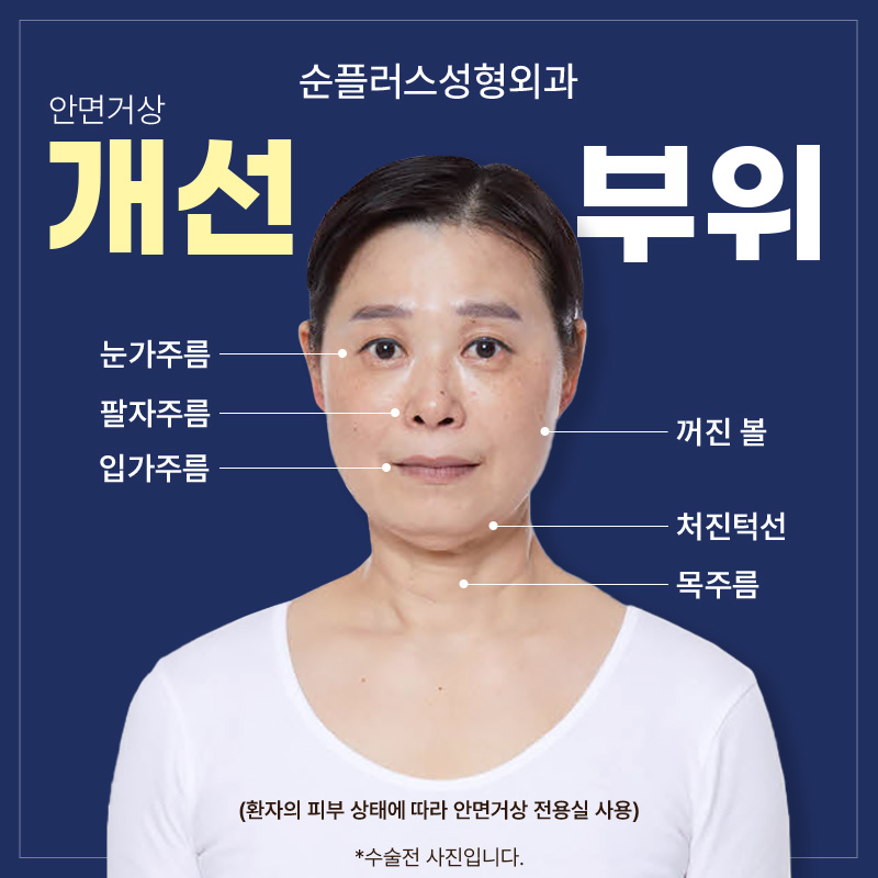 안면거상잘하는곳 핵심 포인트까지 확인 관련 이미지 3