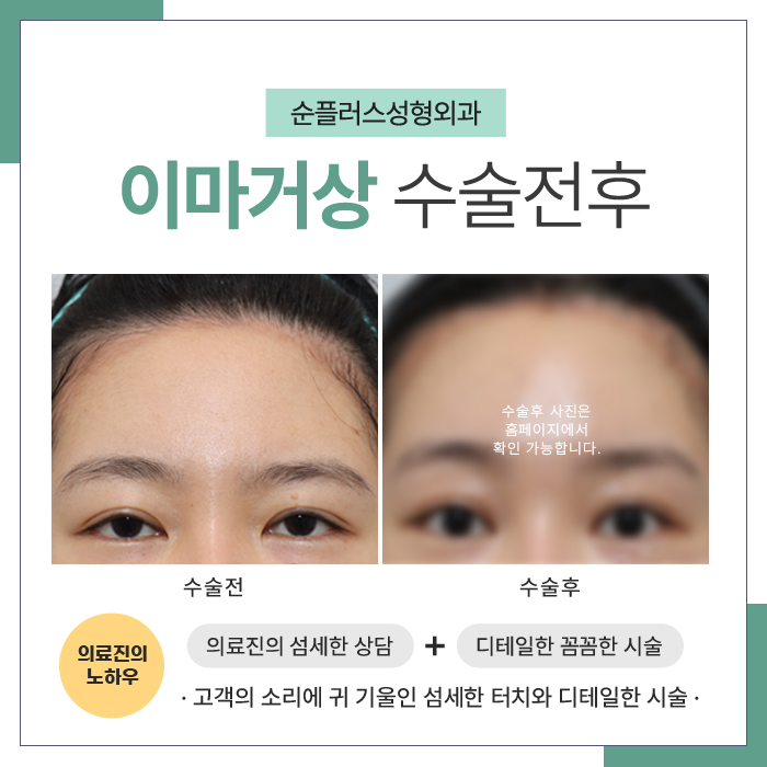 이마거상잘하는병원 나이가 많아도 적어도 관련 이미지 5