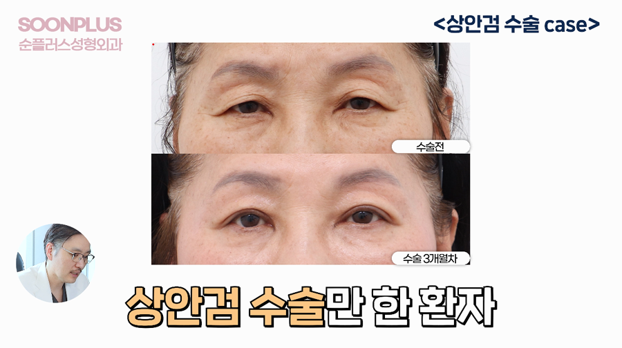 What Surgery Is Performed to Improve Drooping Eyelids and Sagging Eyes, Even by Celebrities? image 3