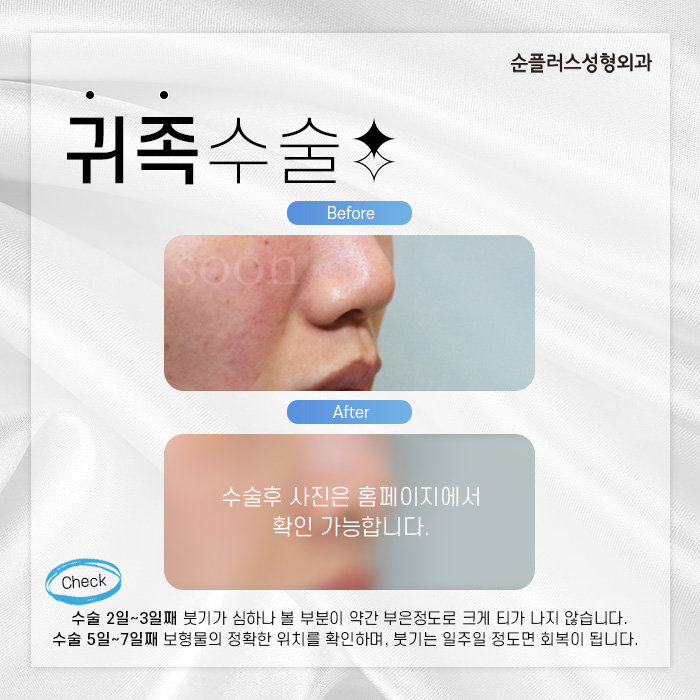 젊은층부터 중년까지 팔자고민엔 귀족수술 관련 이미지 5