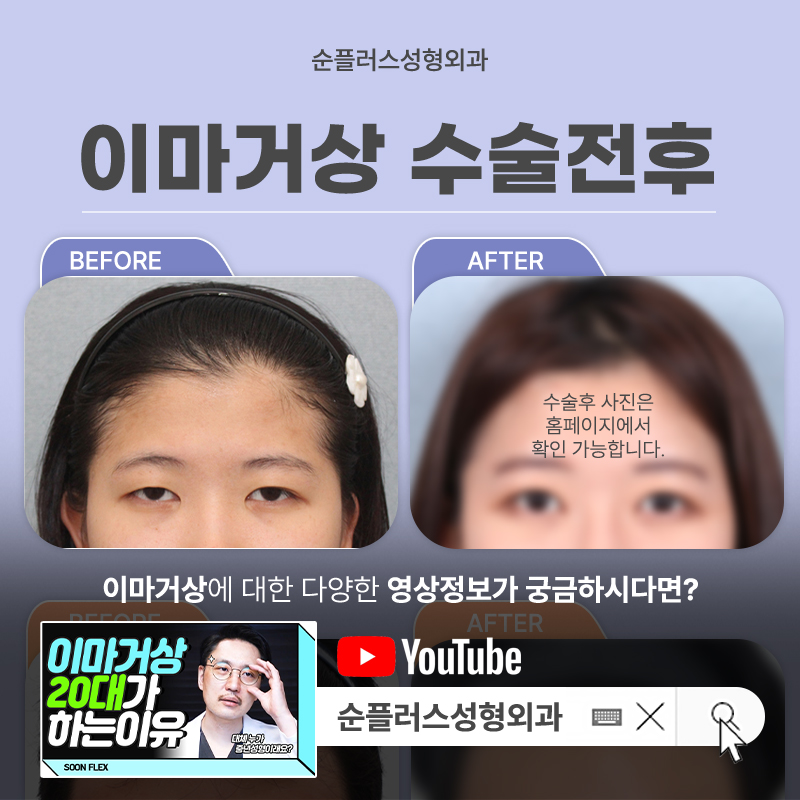 Gangnam Forehead Lift: Pulling the Forehead Skin Also Affects the Eye Area image 7