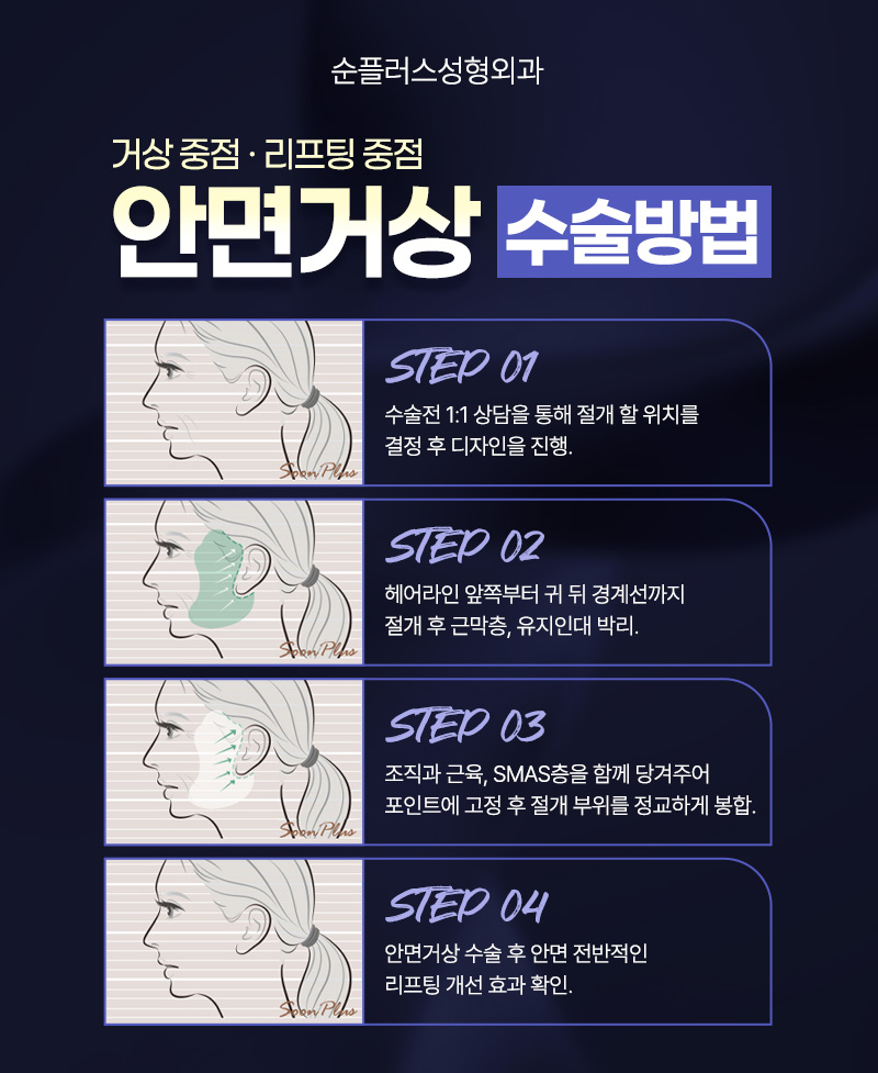 서울 안면거상 추천 자연스럽게 처짐을 끌어올려 관련 이미지 4