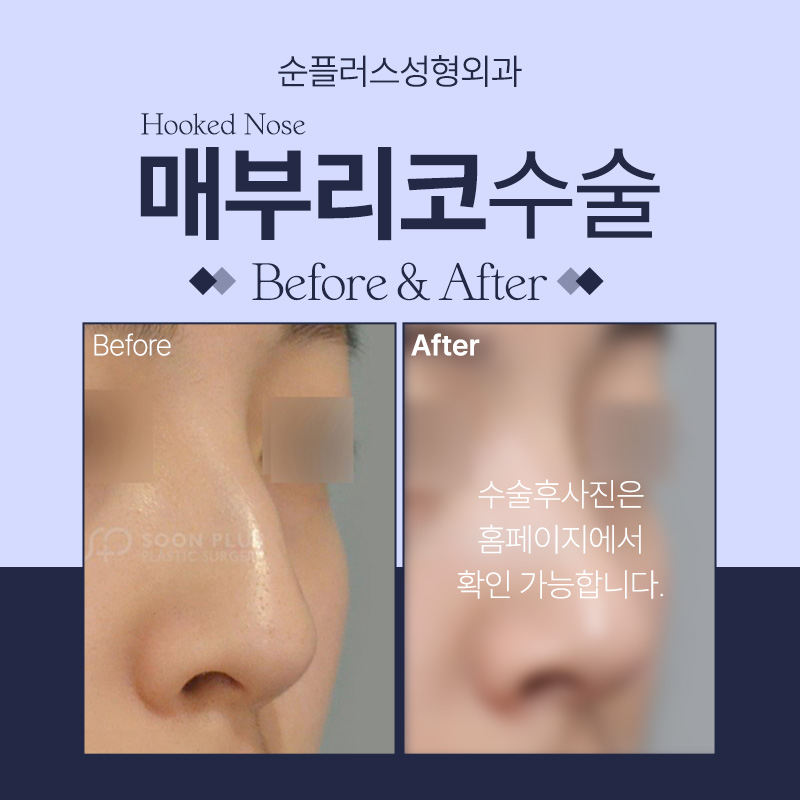 매부리코성형 굴곡짐을 개선해 관련 이미지 4
