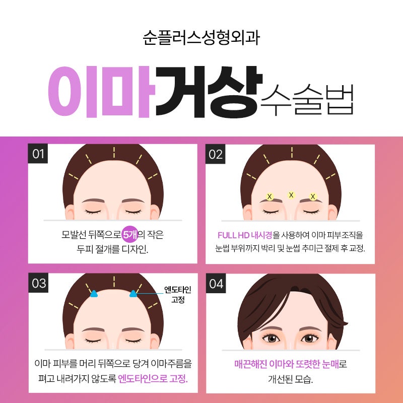 Is forehead lift only recommended for people in their 40s and 50s, and not recommended for people in their 20s and 30s? image 7